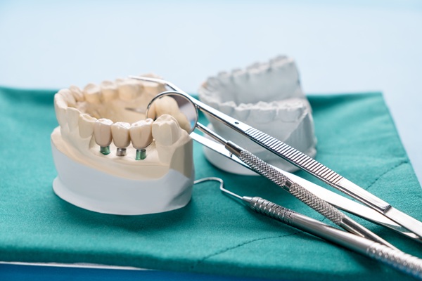 Implant Supported Dentures: What They Are And How They Work